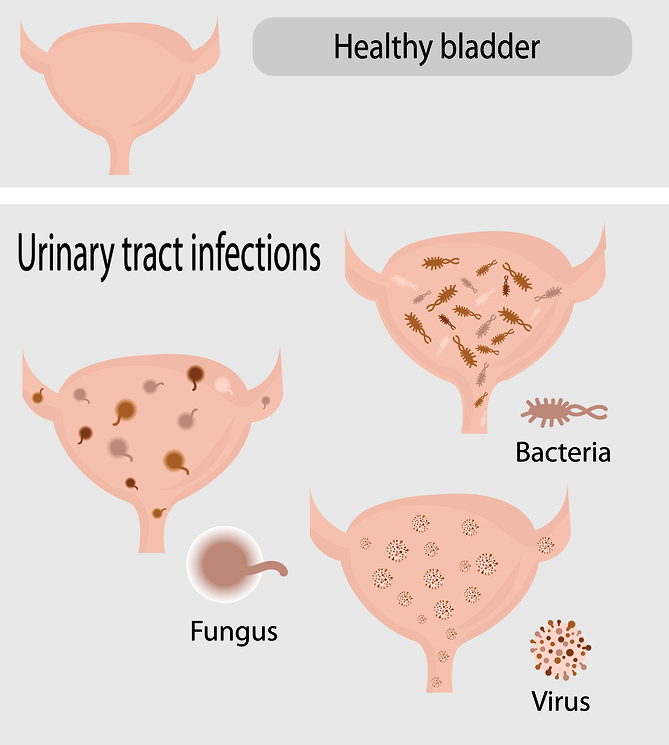 Recurrent Uti Star Clinic