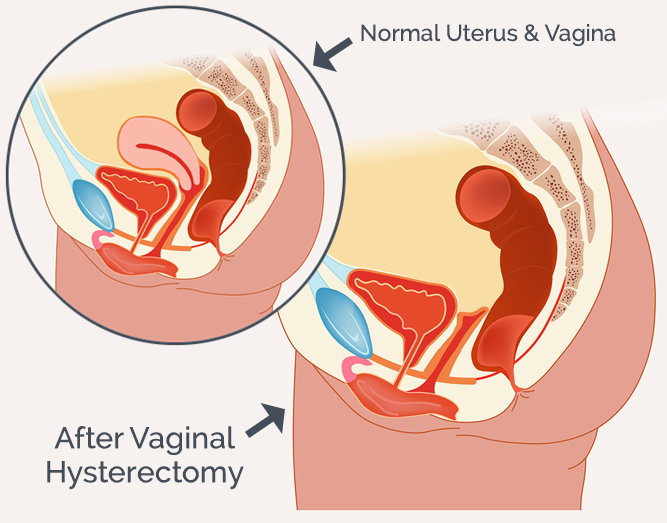 Hysterectomy